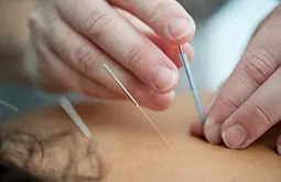 Pregnancy Related acupuncture